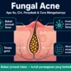 apa itu fungal acne penyebab ciri-ciri dan cara mengatasinya