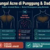 fungal acne di punggung dan dada ciri-ciri cara mengatasi beda dari jerawat badan biasa
